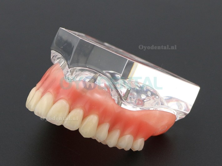 Tandheelkundige studie Tanden Model Overdenture met 4 implantaten Demo Model 6001